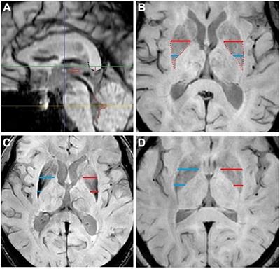 Differentiation of Parkinson’s disease and Parkinsonism predominant multiple system atrophy in early stage by morphometrics in susceptibility weighted imaging